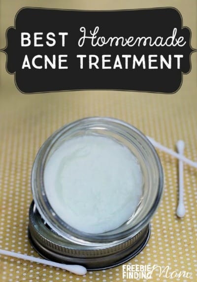 Best Homemade Acne Treatment to promote making homemade beauty products